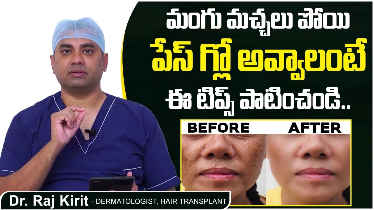 మంగు మచ్చలు పోగొట్టే చిట్కాలు | Melasma Home Remedies in Telugu | Celestee Skin And Hair Clinic