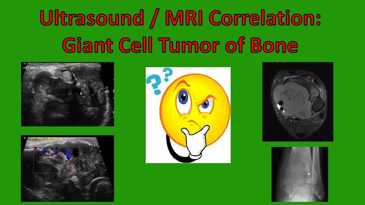Ultrasound / MRI Mass Correlation: Giant Cell Tumor of Bone (updated 2020)