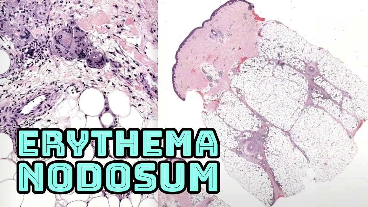Erythema Nodosum (painful red bumps/lumps on legs panniculitis fat necrosis inflammation pathology)