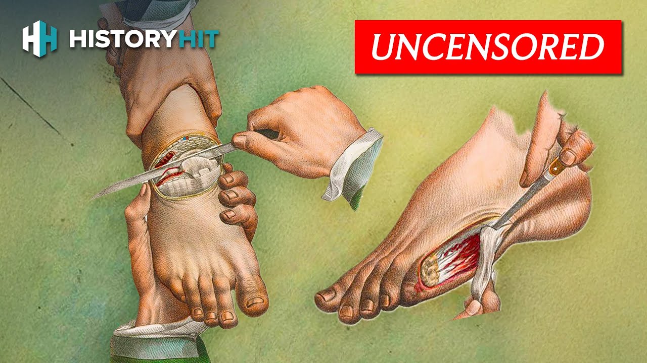 Medical History: Amputations In The Battlefield