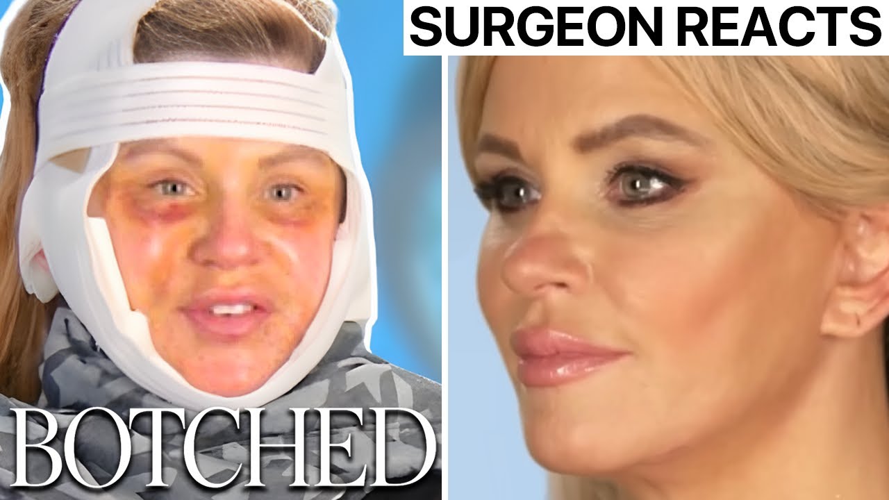 Surgeon Reacts to BOTCHED - Facelift Gone Wrong