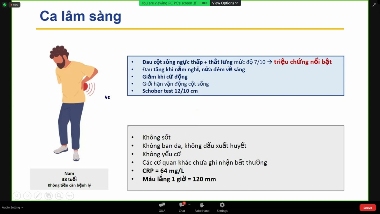 Cập nhật chẩn đoán và điều trị viêm cột sống dính khớp | TS. BS. Cao Thanh Ngọc