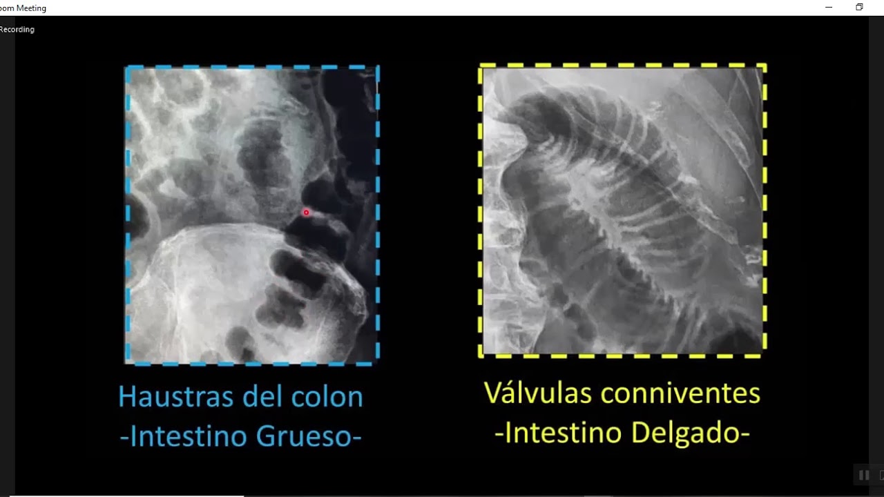 OBSTRUCCION INTESTINAL FULL