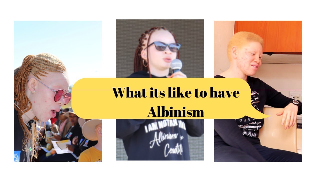 Born Too White: Albinism in Africa| Real Life Experiences