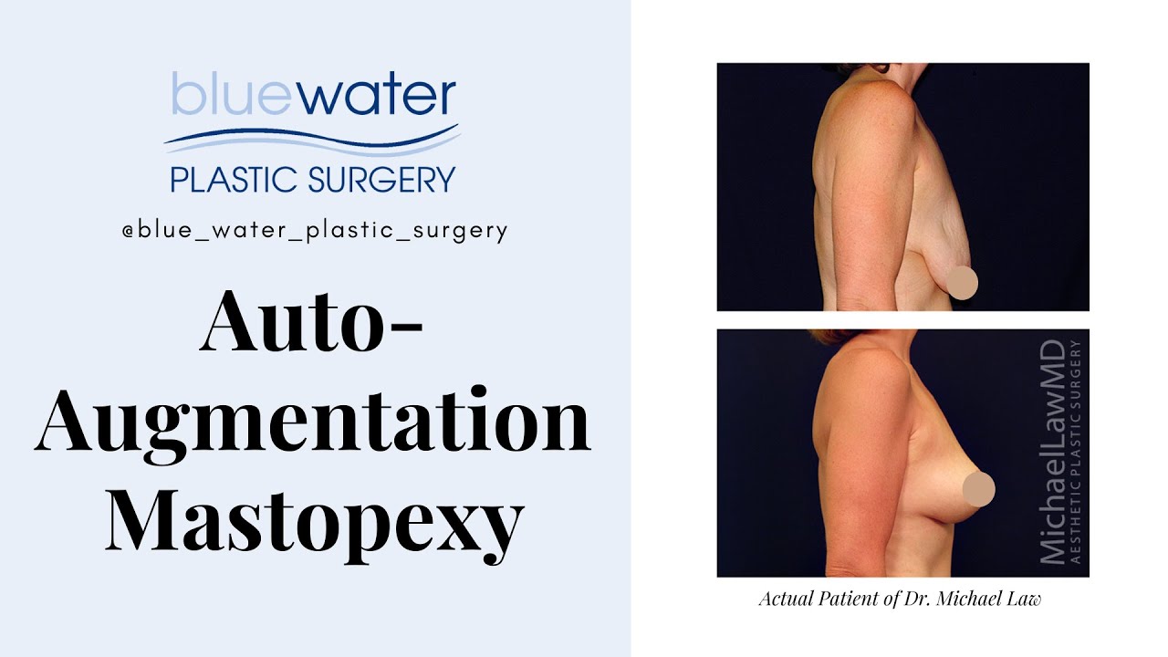 Auto Augmentation Mastopexy by Michael Law MD