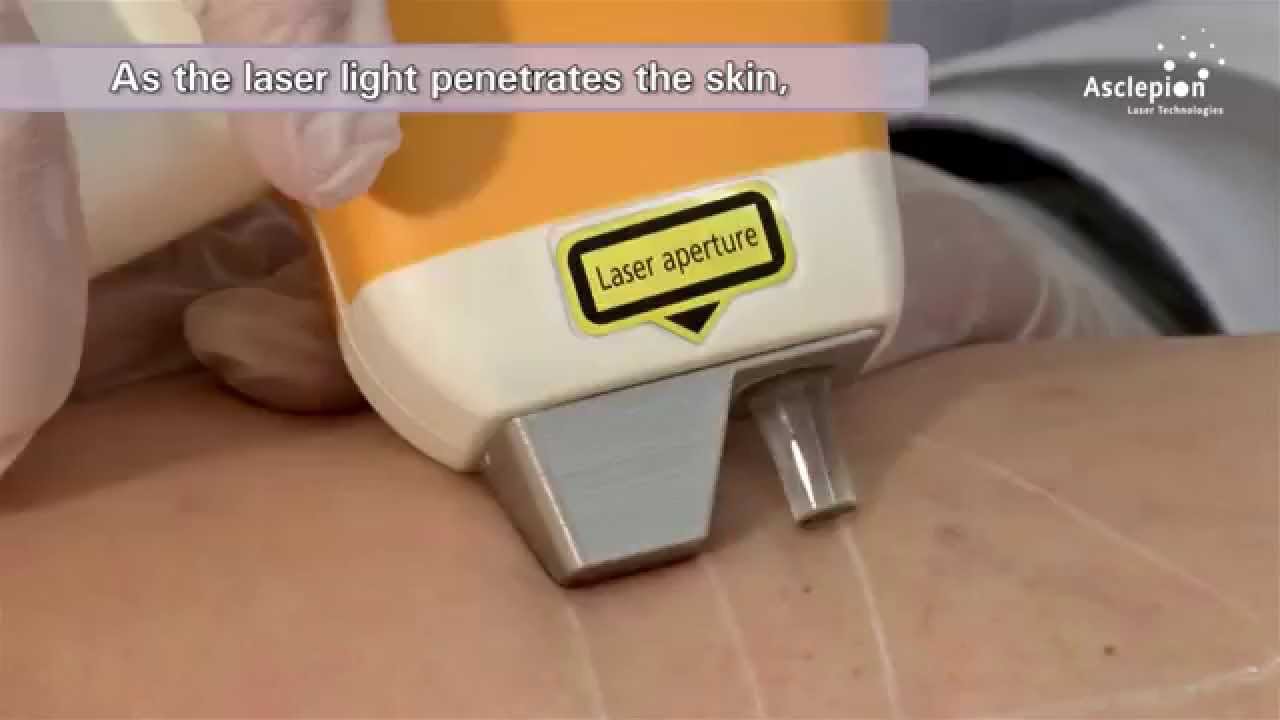 MeDioStar NeXT PRO - Training video for vascular treatment from Asclepion