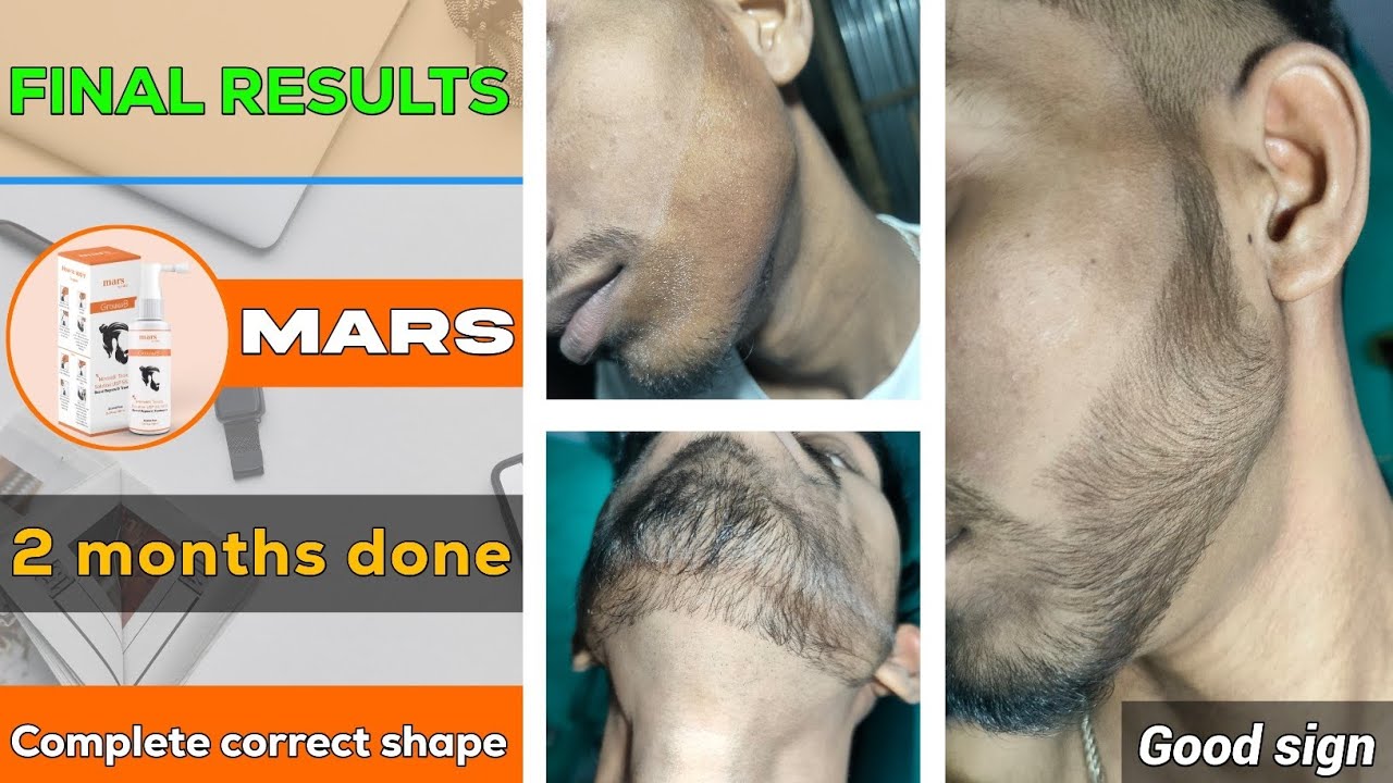 BEARD GROWTH ! Complete fully correct beard shape ! 2 months done ✔️ Final results from minoxidil