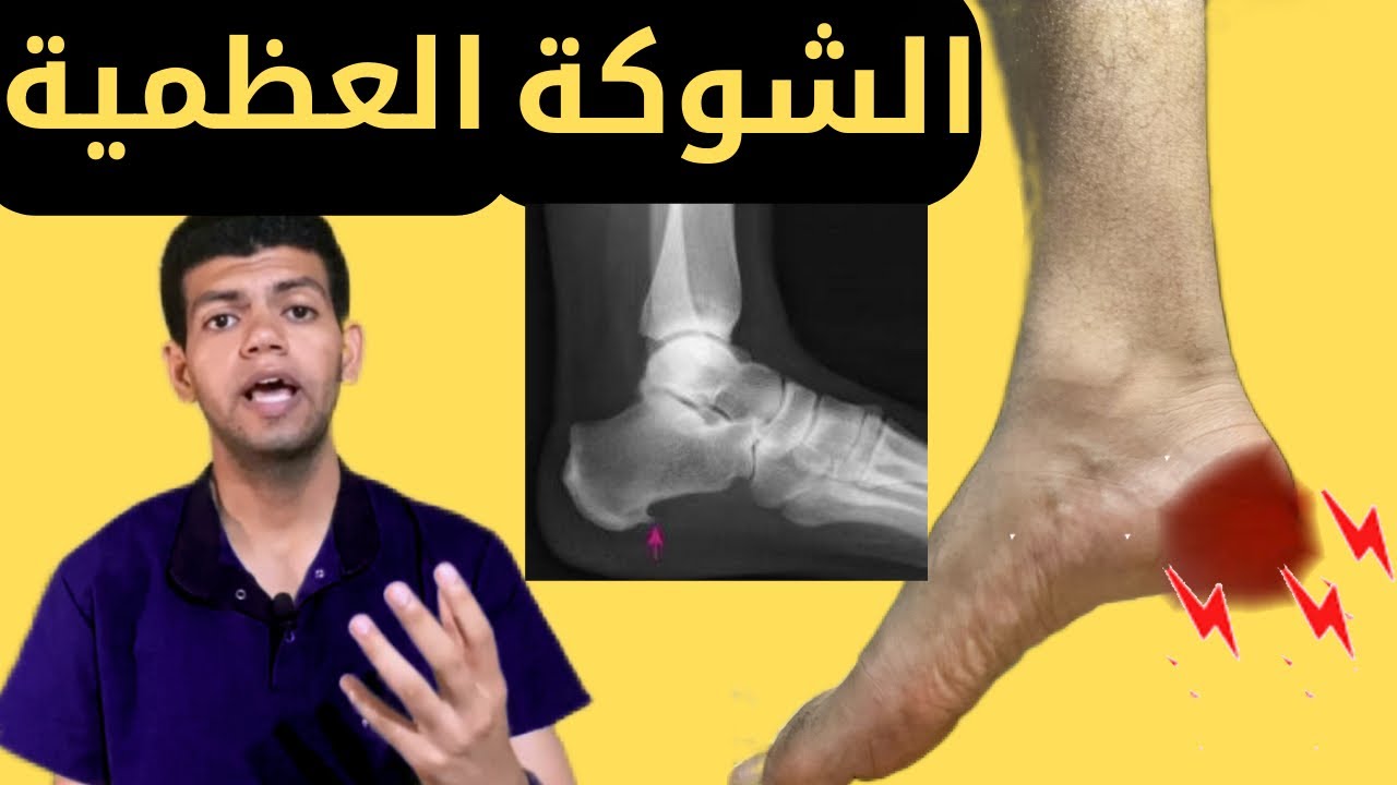 الشوكة العظمية فى الكعب/علاجها بدون تدخل جراحى