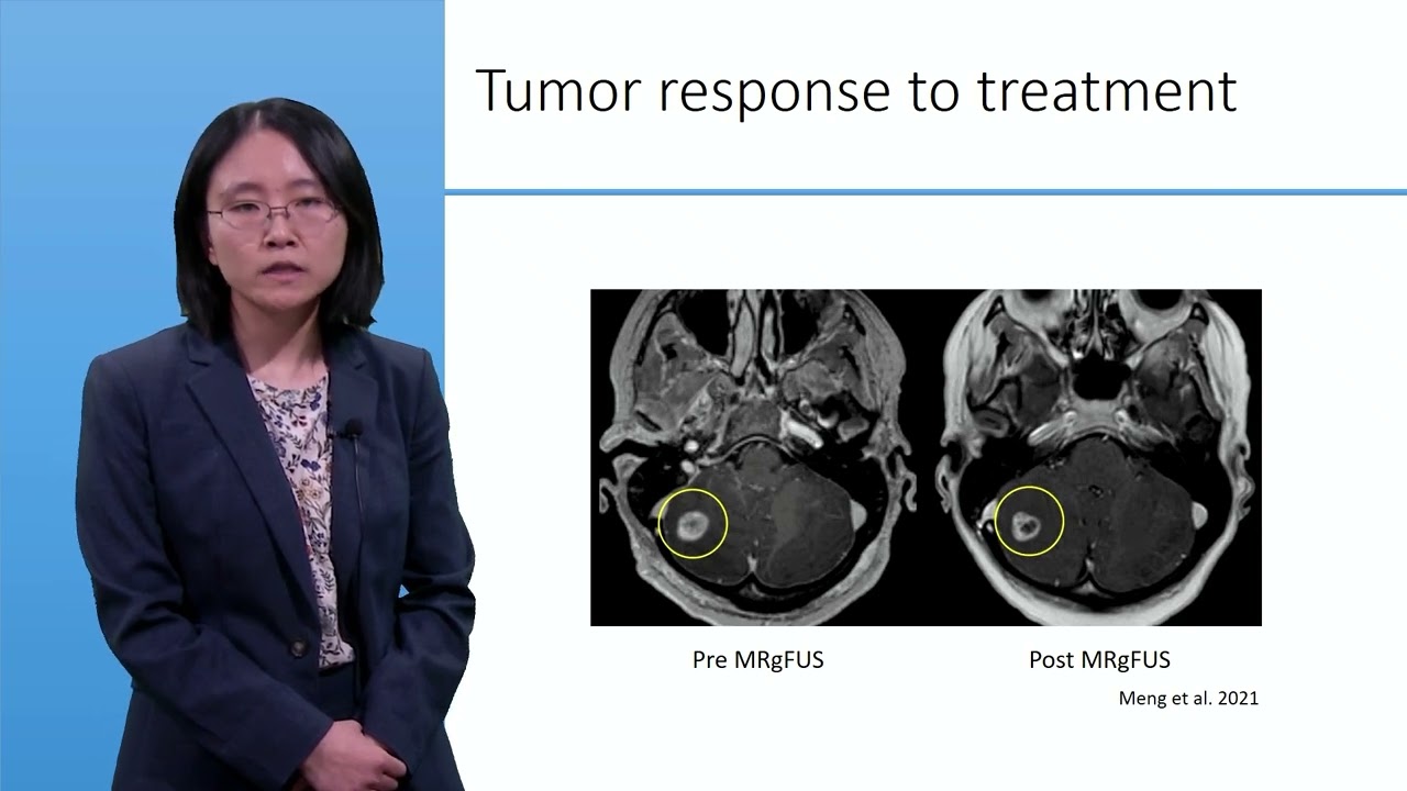 MOOC Course 18 : Focused ultrasound with intravenous microbubbles - Ying Meng - Part3