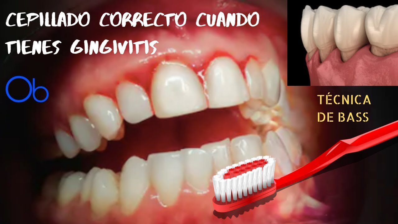 ¿TE SANGRAN LAS ENCÍAS? ¡ESTA TÉCNICA DE CEPILLADO ES PARA TI! - Técnica de Bass
