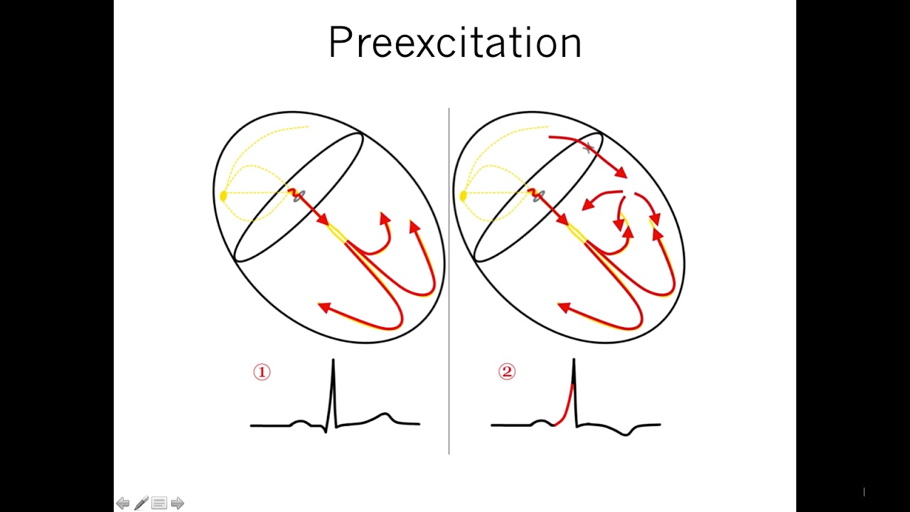 Mechanisms of Arrhythmia: Part 3