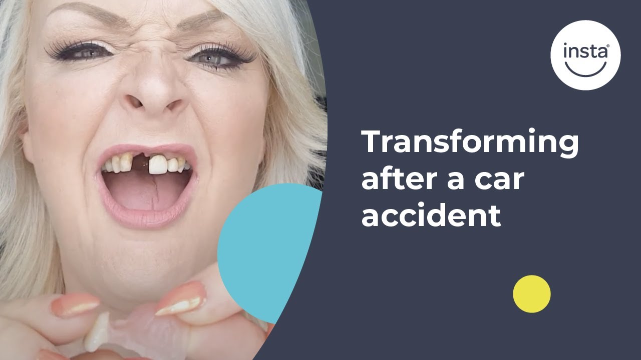 Perfect Smile Transformation After Car Accident | Instasmile Review