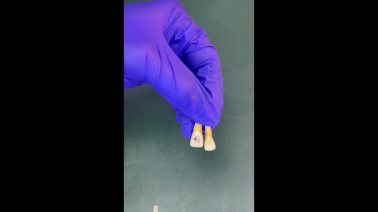 Identification of Extracted permanent Maxillary Incisors