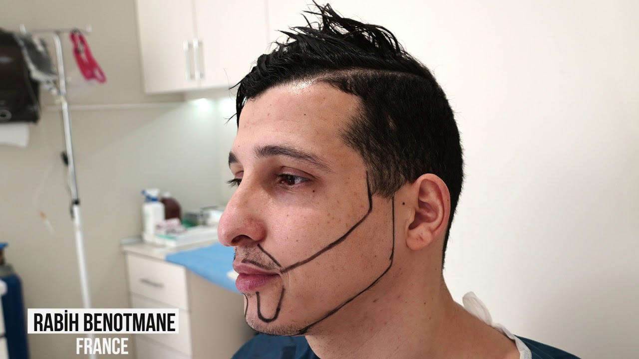 Monsieur Rabih venant de France  le lendemain de sa greffe de barbe.byhairclinic