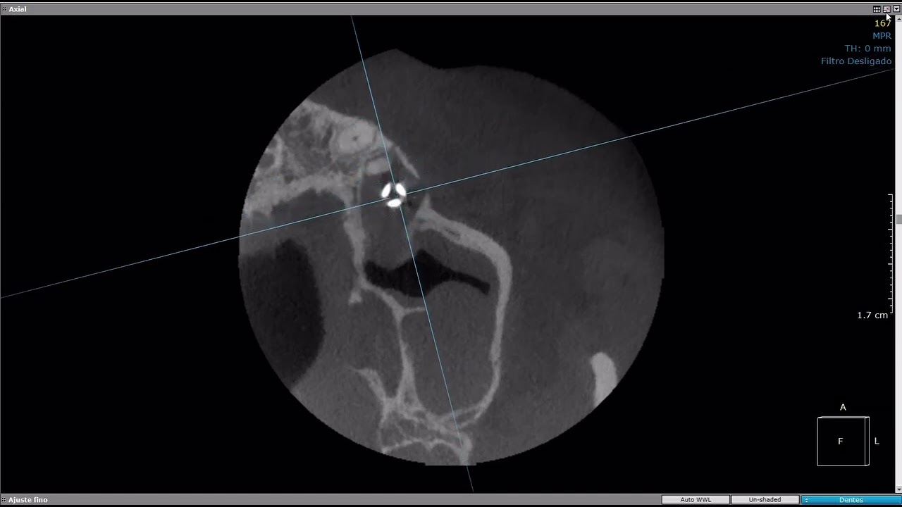 Les&atilde;o periapical peri-implantar ou peri-implantite retr&oacute;grada/periapical
