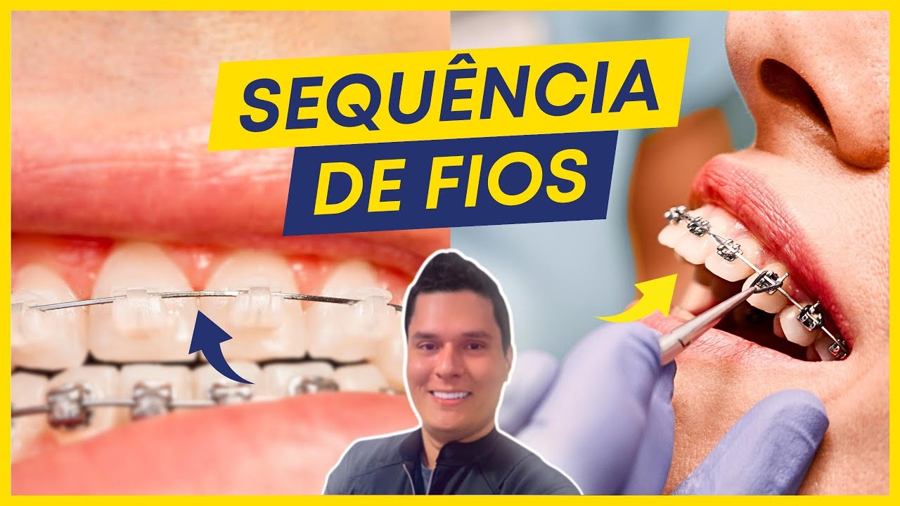 QUAL A SEQUÊNCIA DE FIOS IDEAL EM UM TRATAMENTO ORTODÔNTICO?
