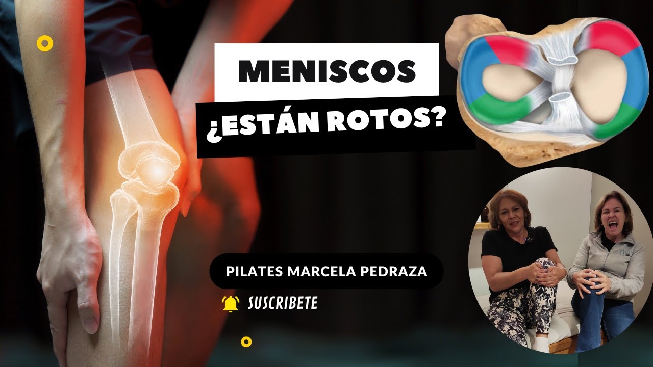 MENISCOS ¿ESTÁN ROTOS?