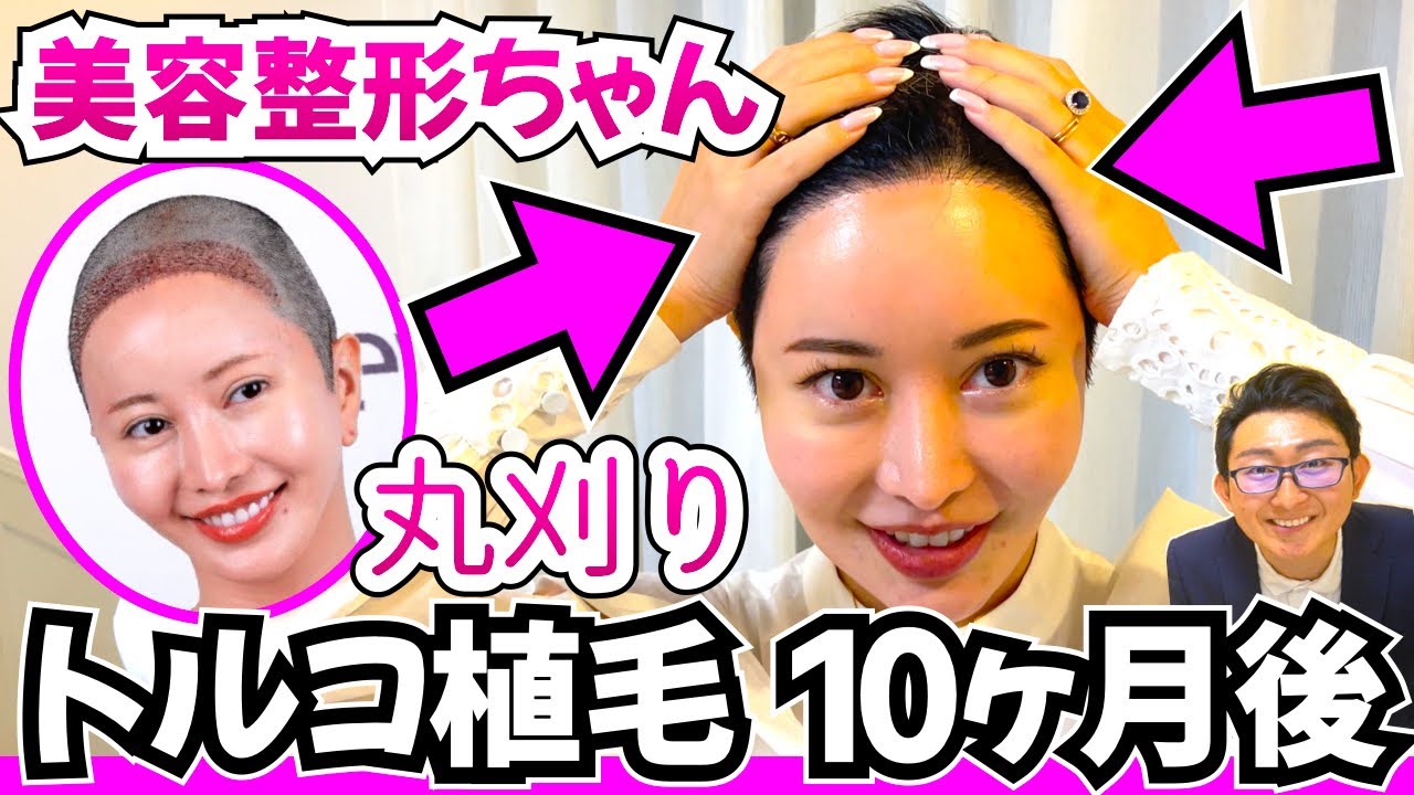 【美容整形ちゃん】トルコ植毛10ヶ月後までの経過を振り返る【薄毛の窓口｜自毛植毛】