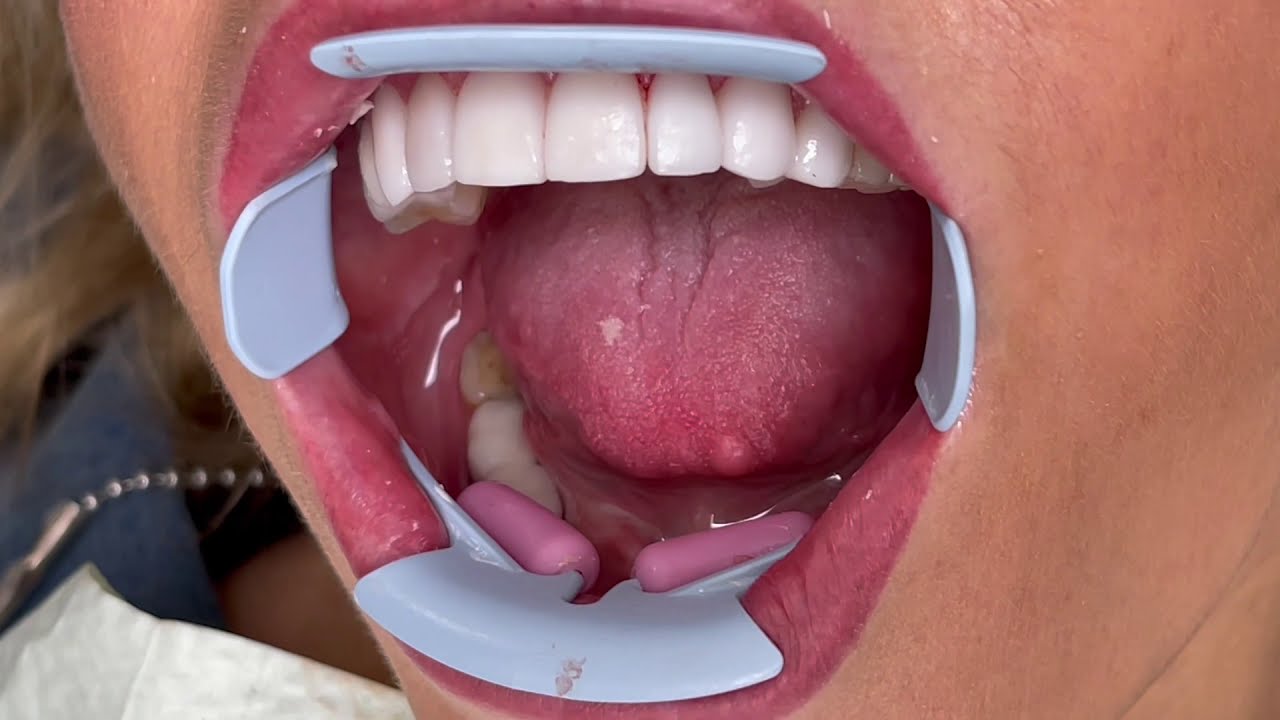 Houston Cosmetic Dentist...Detailed Step by Step placement of Veneers and how to remove the cement