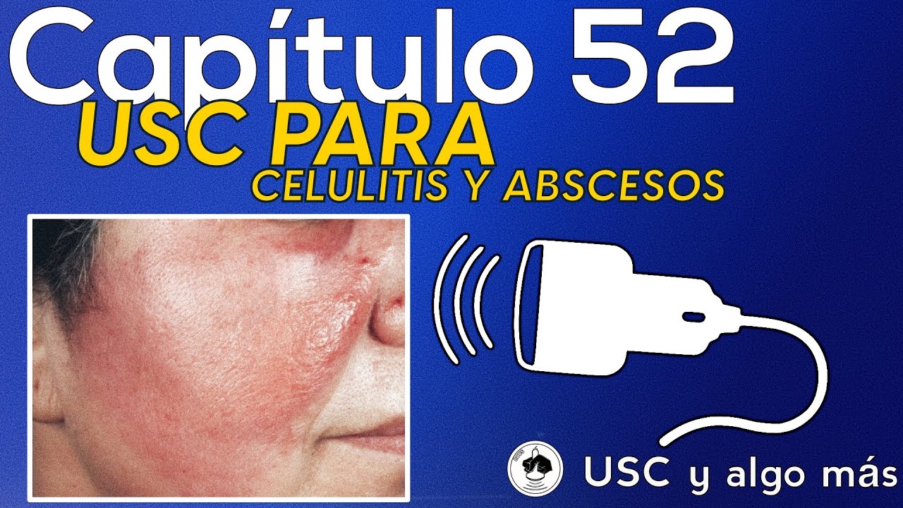 Capitulo 52: USC para el diagnóstico de Celulitis y Abscesos