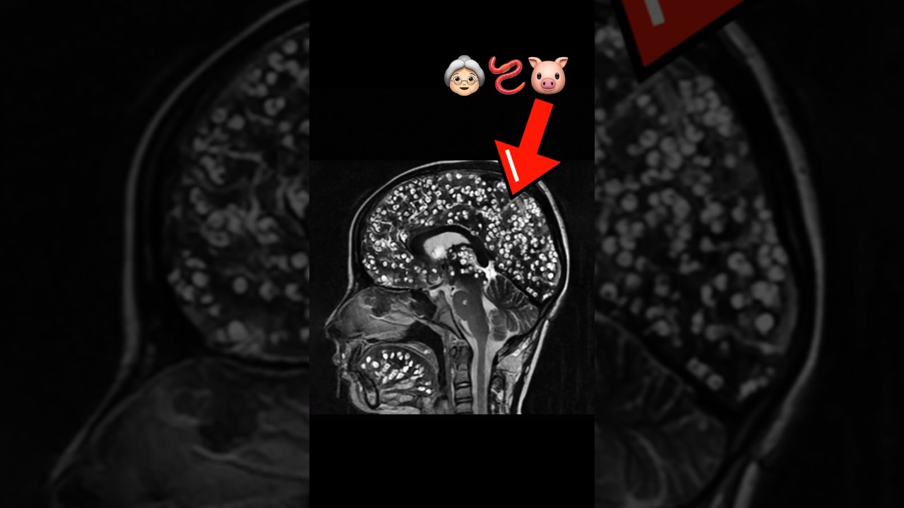 Мозг бабушки был заражен ленточными червями. Вот что произошло дальше… #медицина #паразит