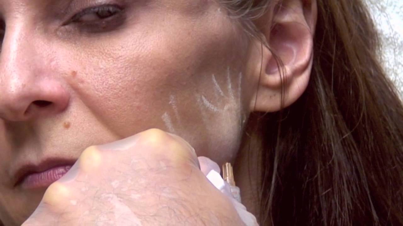 Sculptra for mid face hollowing & temples: Watch live injections-Dr. Gidon Frame