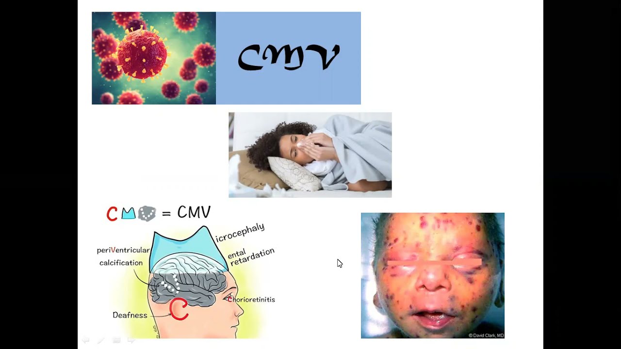All about CMV  MRCOG  with Questions