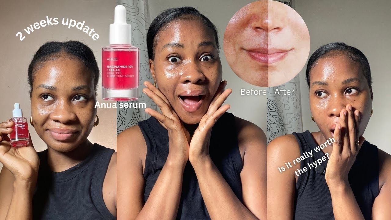 Is Anua  DARK SPOT correcting serum worth the hype? Unfiltered Review