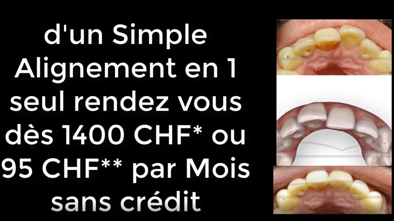Aligner ses dents avec des gouttières chez Orthodontiste ou internet?