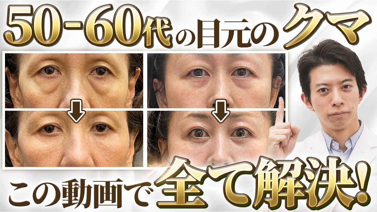 【2025年最新版】失敗する前にこれ1本！50~60代以上の切らずに治せるクマ治療の選択肢とは？【クマ取り / ハムラ法 / 裏ハムラ / 表ハムラ / 脂肪注入 / アンチエイジング】