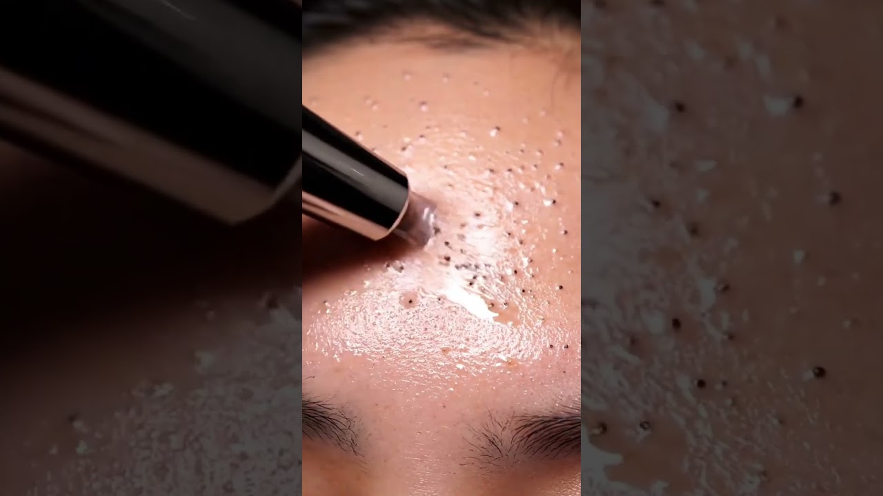 &ldquo;Forehead Pore Vacuum Line Clean ✨ | Perfect Suction ASMR & Smooth Skin&rdquo;