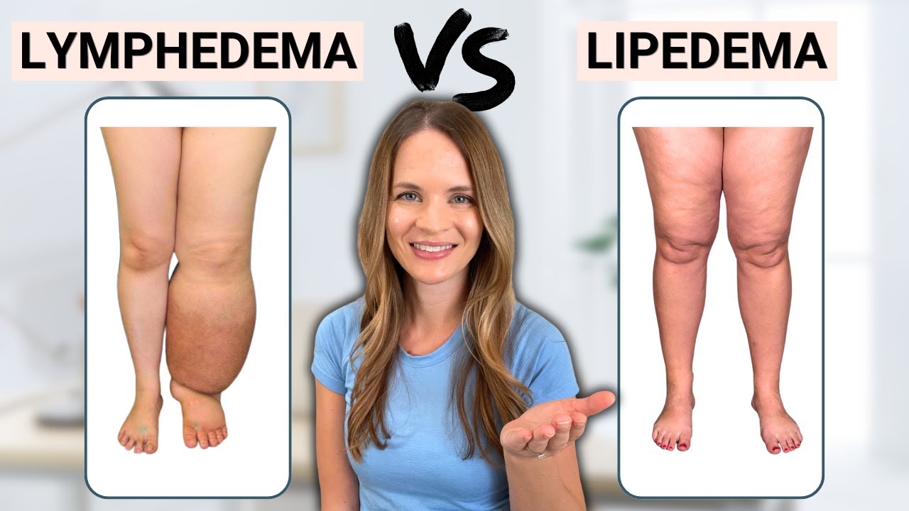 Is it Lymphedema or Lipedema?