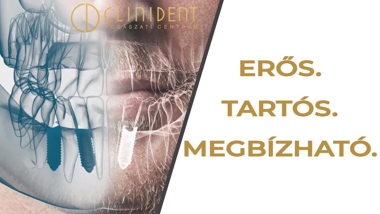 Fogp&oacute;tl&aacute;s kompromisszumok n&eacute;lk&uuml;l: fog implant&aacute;tum szak&eacute;rtőktől