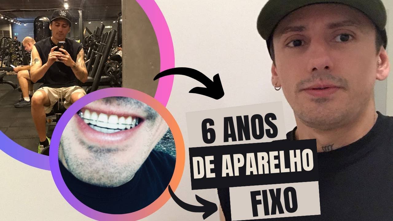 TIREI O APARELHO ORTODÔNTICO FIXO DEPOIS DE 6 ANOS USANDO 😳