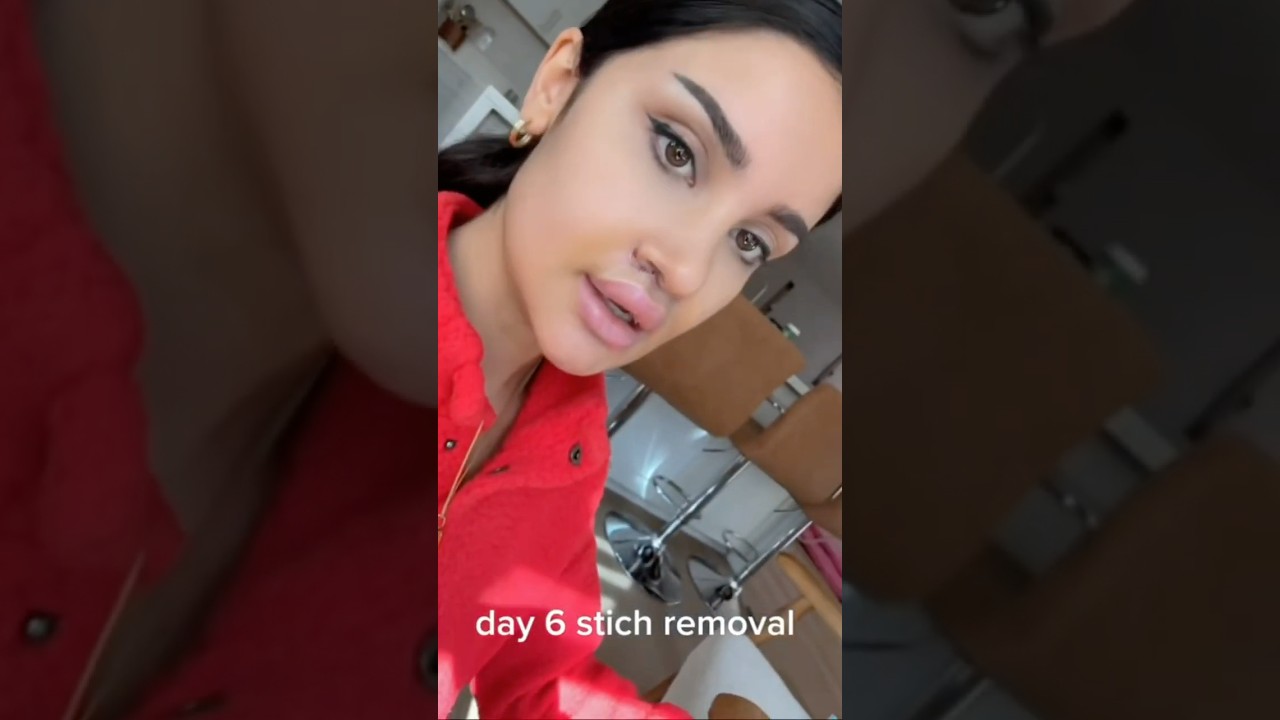 Watch our patients 90-day post lip lift surgery! #costmeticsurgery #liplift #facialplasticsurgery