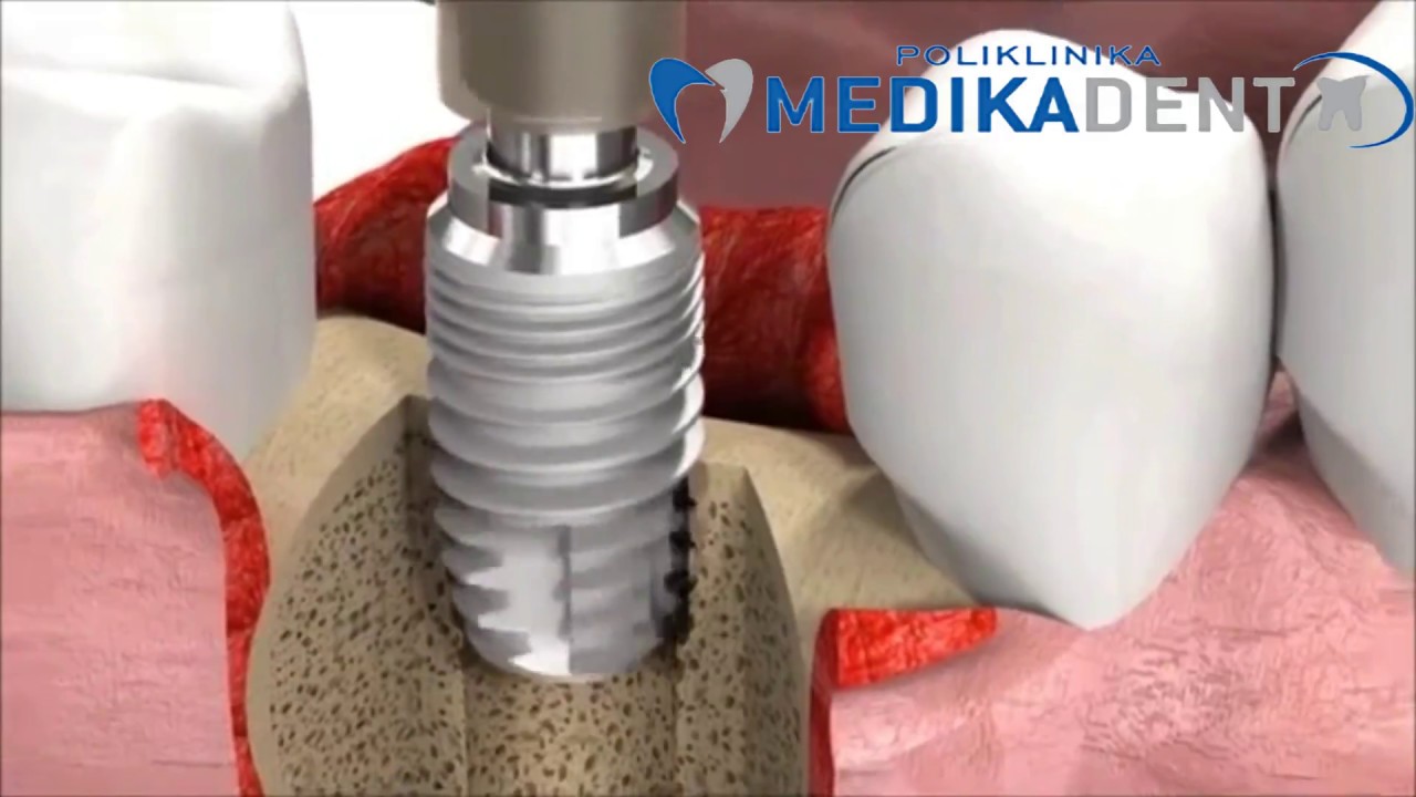 Ugradnja implantata