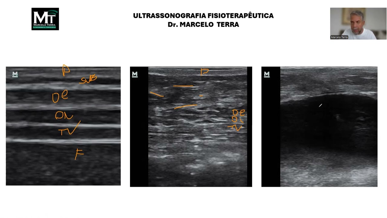 AULA 5 - LESÕES TECIDUAIS - ALTERAÇÕES TECIDUAIS ATRAVÉS DA ULTRASSONOGRAFIA
