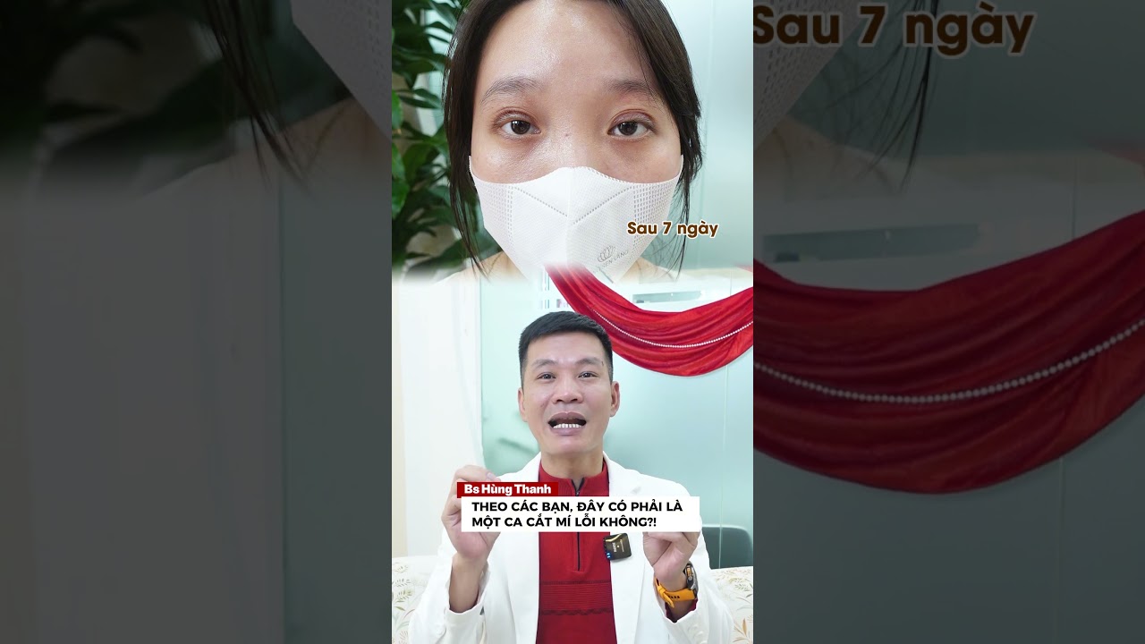 Đây có phải là một case mí bị lỗi? | Bác Sỹ Hùng Thanh - Thẩm Mỹ GN