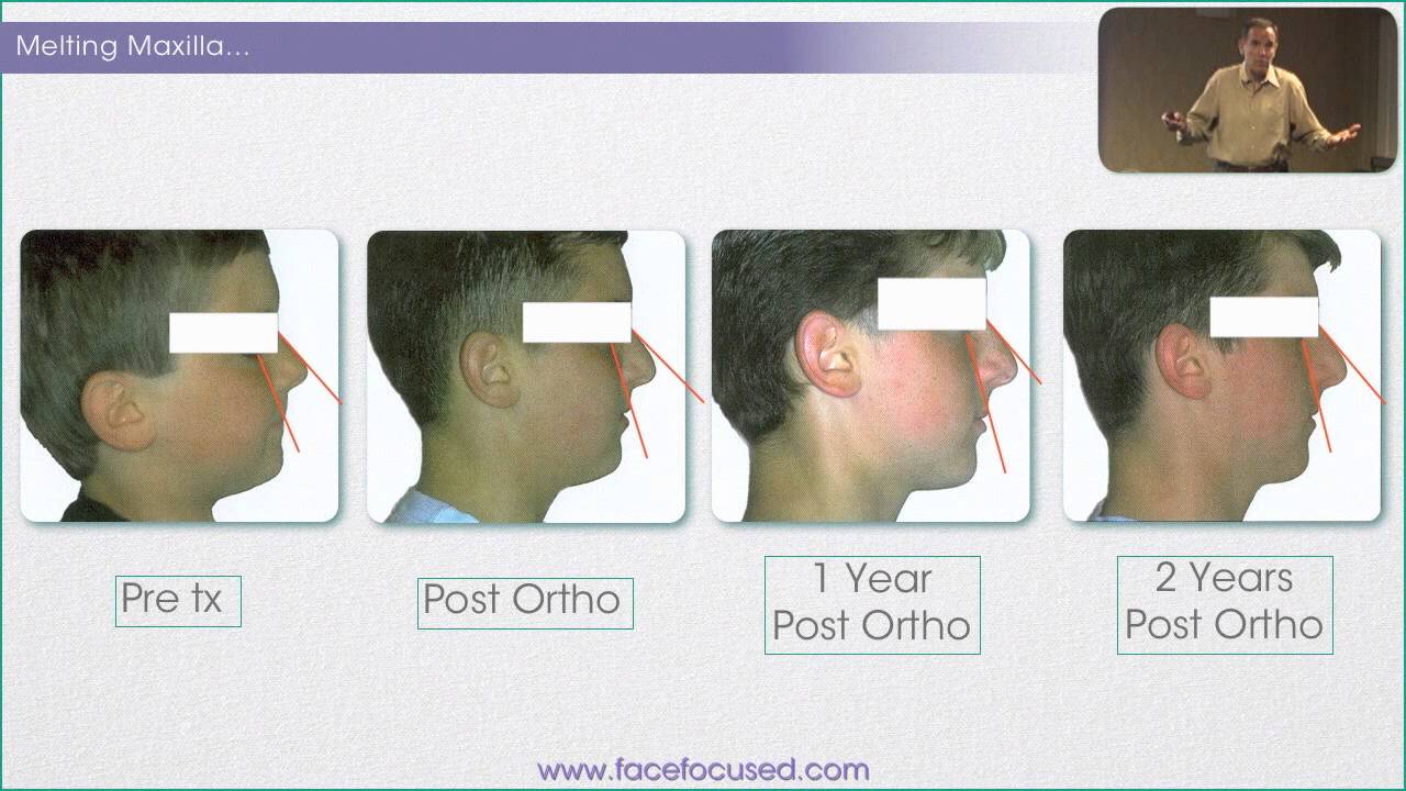 The Case for More Attractive Cheeks and Noses - William M. Hang, DDS, MSD