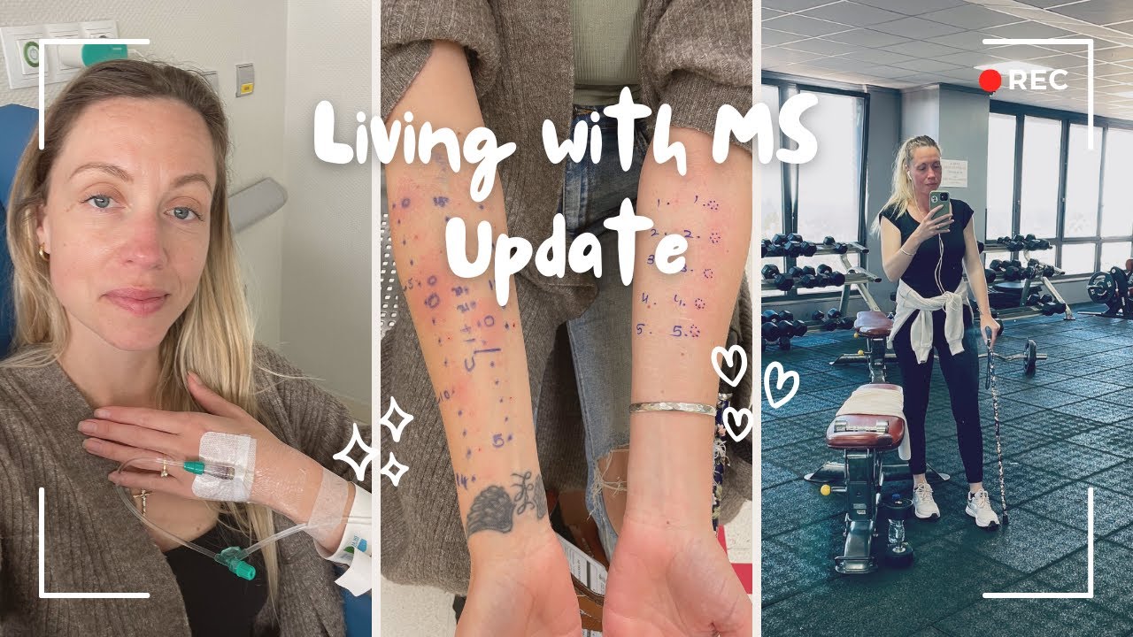 allergic to steroids?! / LIVING WITH AGGRESSIVE RRMS EDSS 6.0/ MULTIPLE SCLEROSIS