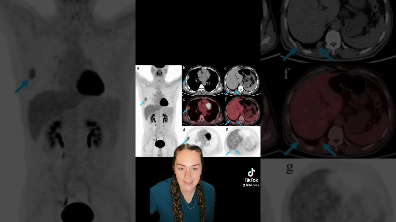 Nuclear Medicine Exams Explained PET/CT FDG