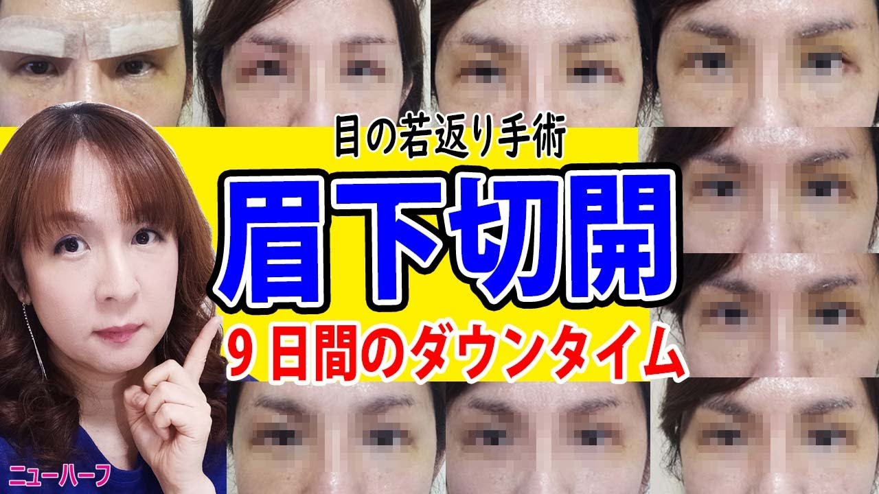 眉下切開9日間のダウンタイム＋おまけ【眼瞼下垂】