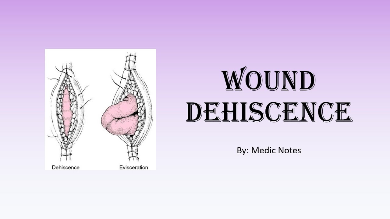 Wound dehiscence - risk factors, clinical features, investigation, management, prevention