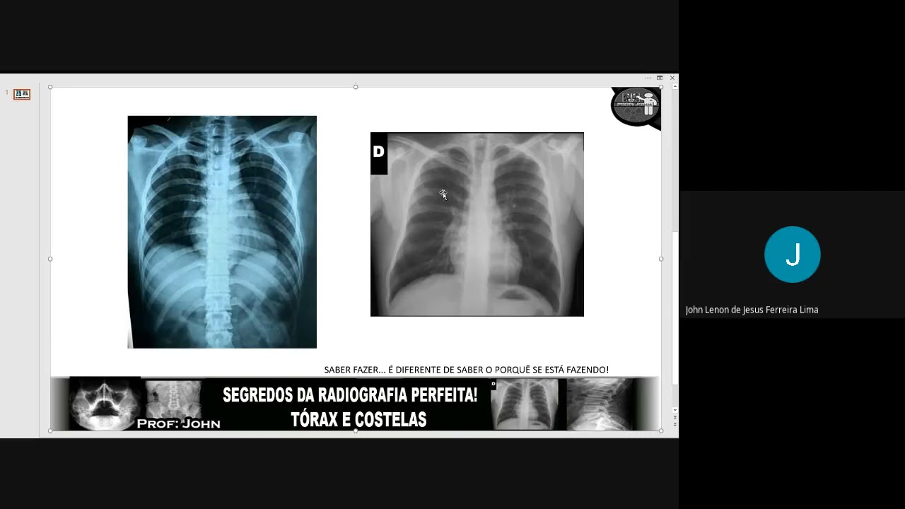 Noções de kV e mAs, posicionamento, técnica  nas radiografias de costelas e tórax!