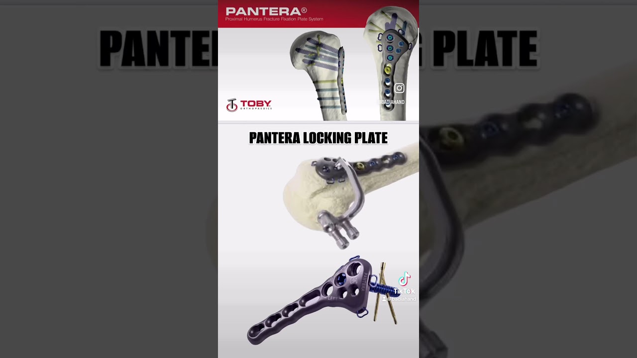 Pre and post op images of a humeral head fracture reduced with the pantera locking plate