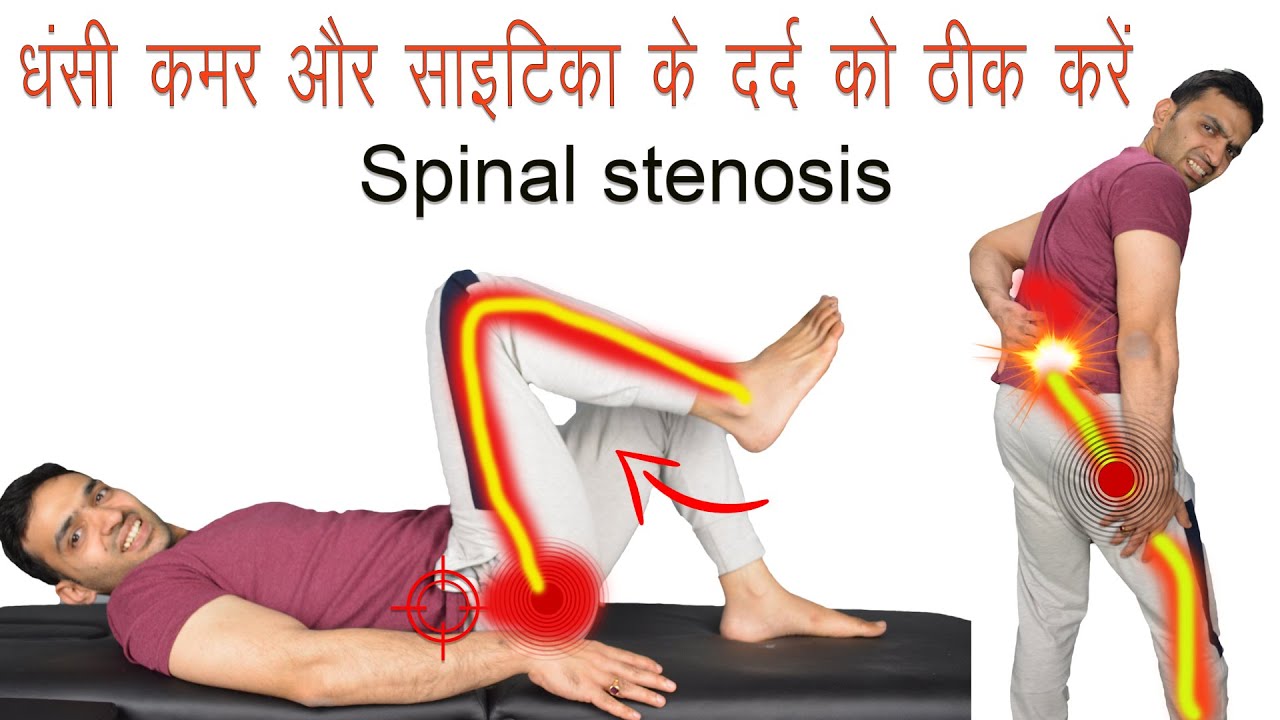 Treat Sciatica Nerve Pain - कमर दर्द ,पैरों में दर्द जाना, झनझनाहट, सुन्नपन, जलन ठीक करें