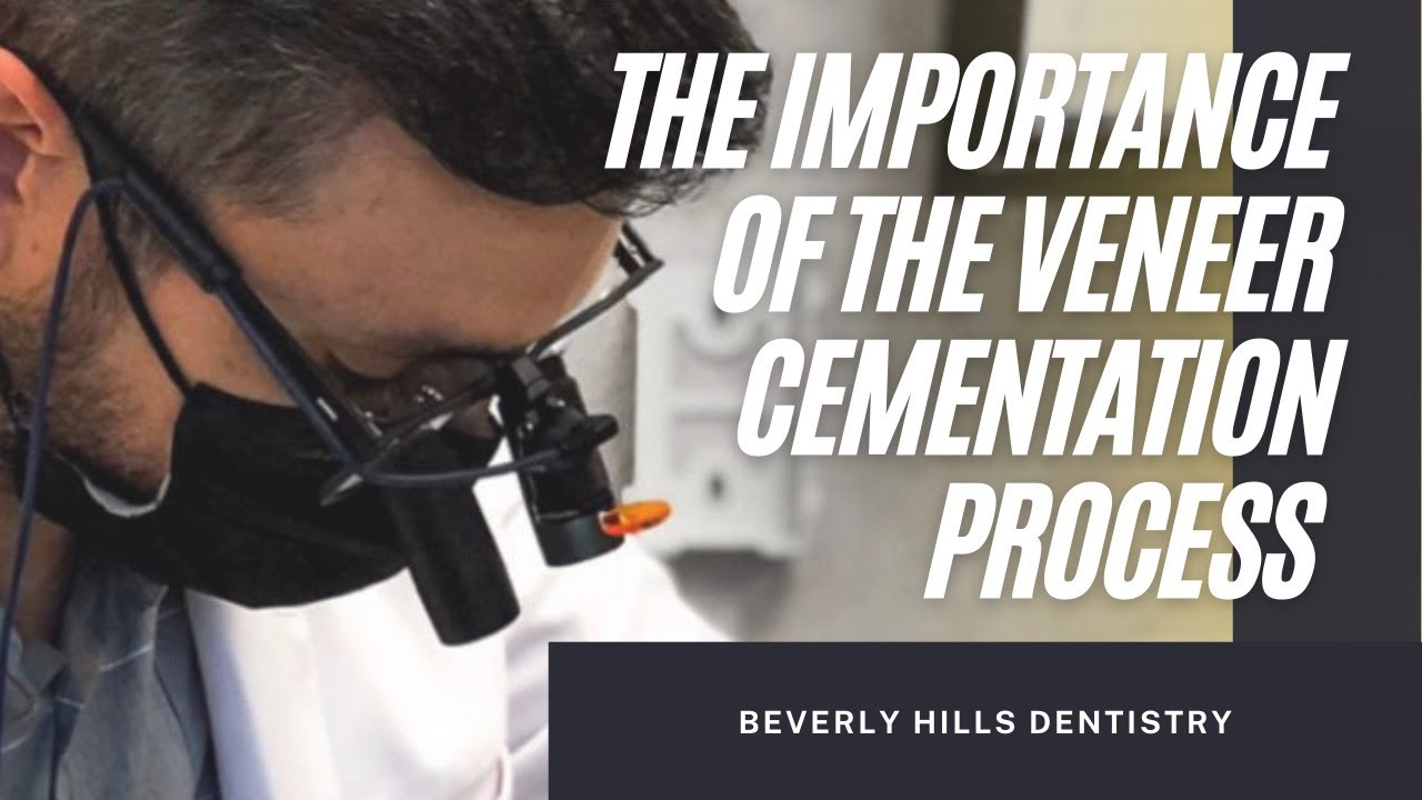 THE IMPORTANCE OF THE VENEER CEMENTATION PROCESS | BeverLy Hills Dentistry