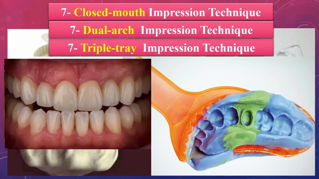 7- Closed-Mouth, Dual-Arch, Triple-Tray Impression Techniques
