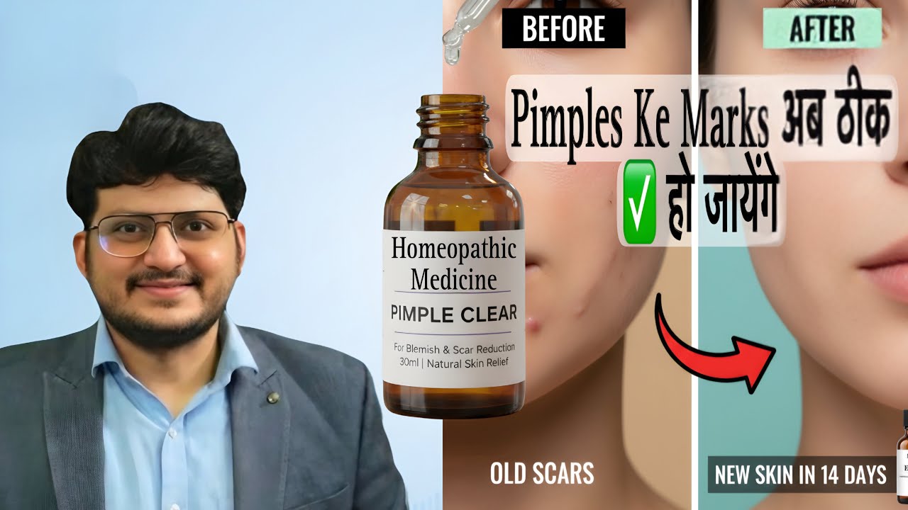 Pimples Ke Marks | Acne Scars | Best Homeopathic Medicine 