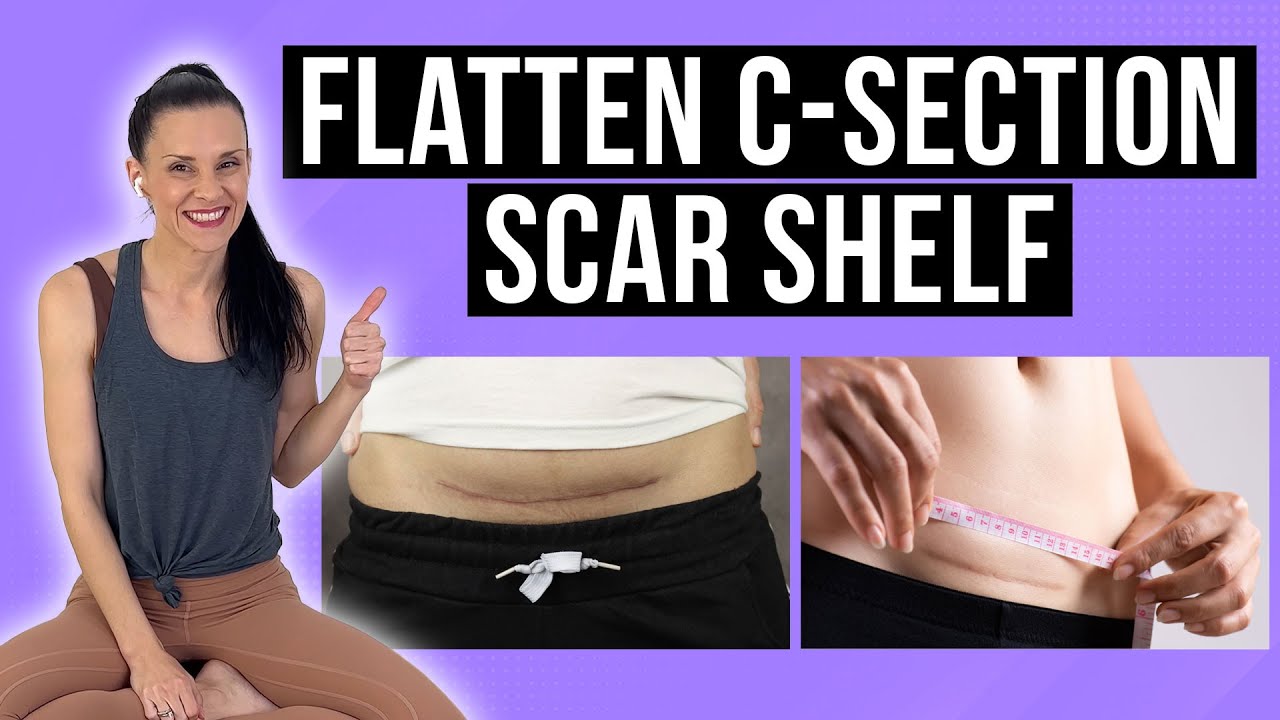 Do This To Your C-Section Scar EVERY DAY To Flatten/Prevent C-Section Scar Shelf